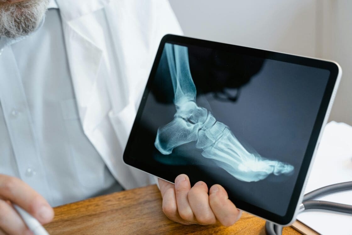 Image of an X-ray of a foot shown on a doctor's iPad to illustrate an osteoporosis break to a patient.